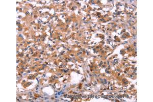Immunohistochemistry of Human thyroid cancer using LILRB1 Polyclonal Antibody at dilution of 1:30 (LILRB1 antibody)
