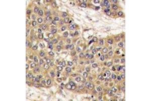 IHC analysis of FFPE human hepatocarcinoma tissue stained with Caspase-6 antibody