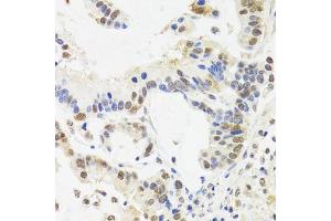 Immunohistochemistry of paraffin-embedded human gastric cancer using SUZ12 antibody (ABIN5975314) at dilution of 1/100 (40x lens). (SUZ12 antibody)