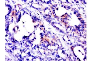 Paraformaldehyde-fixed, paraffin embedded human stomach cancer, Antigen retrieval by boiling in sodium citrate buffer (pH6. (PSCA antibody  (AA 24-123))