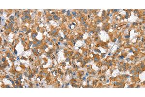 Immunohistochemistry of paraffin-embedded Human thyroid cancer tissue using CSMD1 Polyclonal Antibody at dilution 1:40 (CSMD1 antibody)