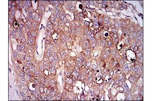 Immunohistochemical analysis of paraffin-embedded esophageal cancer tissues using NT5E mouse mAb with DAB staining. (CD73 antibody  (AA 30-250))
