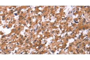 Immunohistochemistry of paraffin-embedded Human thyroid cancer using HSD17B1 Polyclonal Antibody at dilution of 1:40 (HSD17B1 antibody)