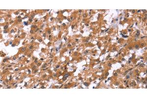 Immunohistochemistry of paraffin-embedded Human thyroid cancer using HSD17B1 Polyclonal Antibody at dilution of 1:40