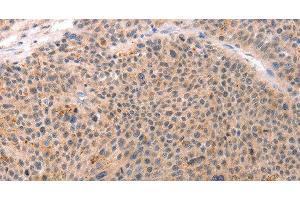 Immunohistochemistry of paraffin-embedded Human esophagus cancer tissue using ACIN1 Polyclonal Antibody at dilution 1:80 (ACIN1 antibody)