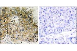 Immunohistochemistry analysis of paraffin-embedded human breast carcinoma, using Integrin beta1 (Phospho-Thr789) Antibody. (ITGB1 antibody  (pThr789))
