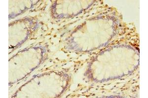 Immunohistochemistry of paraffin-embedded human colon cancer using ABIN7161747 at dilution of 1:100 (NAIF1 antibody  (AA 1-172))