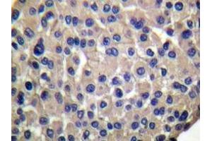 Immunohistochemistry analyzes of Mucin 1 antibody in paraffin-embedded human breast carcinoma. (MUC1 antibody)