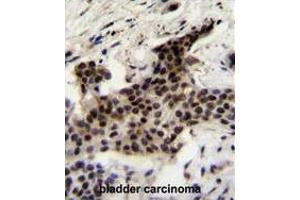 UBXN2A Antibody (C-term) immunohistochemistry analysis in formalin fixed and paraffin embedded human bladder carcinoma followed by peroxidase conjugation of the secondary antibody and DAB staining. (UBXN2A antibody  (C-Term))