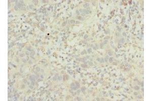 Immunohistochemistry of paraffin-embedded human bladder cancer using ABIN7163723 at dilution of 1:100 (POC1B antibody  (AA 299-478))