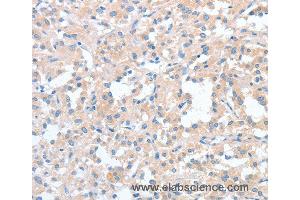 Immunohistochemistry of Human thyroid cancer using WNT3A Polyclonal Antibody at dilution of 1:40 (WNT3A antibody)