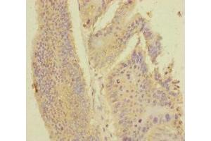 Immunohistochemistry of paraffin-embedded human colon cancer using ABIN7168416 at dilution of 1:100 (PDE6A antibody  (AA 656-860))