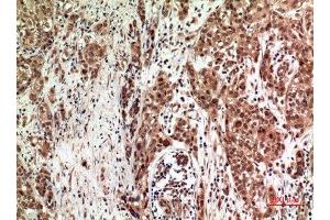 Immunohistochemistry (IHC) analysis of paraffin-embedded Human Breast Cancer, antibody was diluted at 1:100. (ZFPM2 antibody)