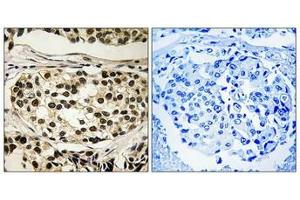 Immunohistochemical analysis of paraffin-embedded human breast carcinoma tissue using Cyclin C (Phospho-Ser275) antibody (left)or the same antibody preincubated with blocking peptide (right). (Cyclin C antibody  (pSer275))
