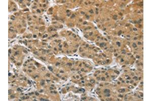The image on the left is immunohistochemistry of paraffin-embedded Human liver cancer tissue using ABIN7129356(ELAC2 Antibody) at dilution 1/30, on the right is treated with fusion protein. (ELAC2 antibody)