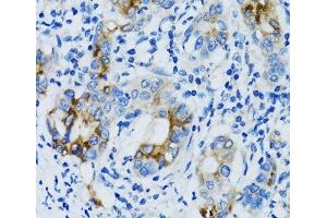 Immunohistochemistry of paraffin-embedded Human gastric cancer using MMP7 Polyclonal Antibody at dilution of 1:100 (40x lens). (MMP7 antibody)