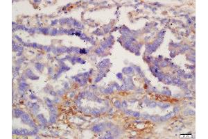 Formalin-fixed and paraffin embedded human lung carcinoma labeled with Anti-IL-12 beta Polyclonal Antibody, Unconjugated  at 1:200 followed by conjugation to the secondary antibody and DAB staining. (IL12B antibody  (AA 201-300))