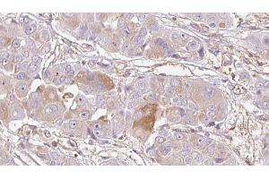 ABIN6272735 at 1/100 staining Human liver cancer tissue by IHC-P. (LPAR4 antibody  (C-Term))