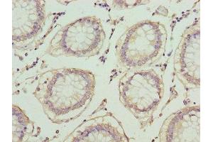Immunohistochemistry of paraffin-embedded human colon cancer using ABIN7163613 at dilution of 1:100 (PLA2G7 antibody  (AA 49-441))