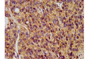 IHC image of ABIN7159750 diluted at 1:400 and staining in paraffin-embedded human glioma performed on a Leica BondTM system.