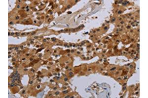 The image on the left is immunohistochemistry of paraffin-embedded Human prostate cancer tissue using ABIN7190333(COX18 Antibody) at dilution 1/20, on the right is treated with synthetic peptide. (COX18 antibody)