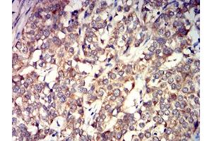 Immunohistochemical analysis of paraffin-embedded bladder cancer tissues using GRIK4 mouse mAb with DAB staining. (GRIK4 antibody  (AA 21-166))