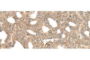 Immunohistochemistry of paraffin-embedded Human liver cancer tissue using APC Polyclonal Antibody at dilution of 1:45(x200) (APC antibody)