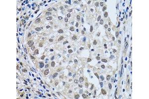 Immunohistochemistry of paraffin-embedded Human lung cancer using LSM4 Polyclonal Antibody at dilution of 1:100 (40x lens). (LSM4 antibody)
