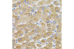 Immunohistochemistry of paraffin-embedded human liver damage using Mitofusin 2 antibody (ABIN6128301, ABIN6143801, ABIN6143804 and ABIN6217669) (40x lens). (MFN2 antibody  (AA 687-757))