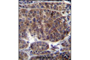 PREF3 Antibody (C-term) (ABIN656587 and ABIN2845849) immunohistochemistry analysis in formalin fixed and paraffin embedded human melanoma followed by peroxidase conjugation of the secondary antibody and DAB staining. (PRAMEF3 antibody  (C-Term))