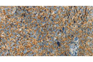 Immunohistochemistry of paraffin-embedded Human cervical cancer using BCAT2 Polyclonal Antibody at dilution of 1:70 (BCAT2 antibody)