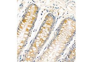 Immunohistochemistry of paraffin embedded human colon cancer using AnnexinA13 (ABIN7073061) at dilution of 1:1500 (400x lens) (Annexin A13 antibody)
