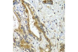 Immunohistochemistry of paraffin-embedded human liver cancer using CDC16 antibody (ABIN5974330) at dilution of 1/100 (40x lens).