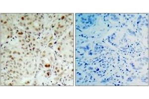 Immunohistochemistry analysis of paraffin-embedded human breast carcinoma, using Retinoblastoma (Phospho-Ser807) Antibody. (Retinoblastoma Protein (Rb) antibody  (pSer807))