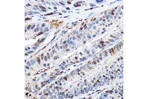 Immunohistochemistry of paraffin-embedded human colon carcinoma using CDK2 Rabbit pAb  at dilution of 1:200 (40x lens). (CDK2 antibody)