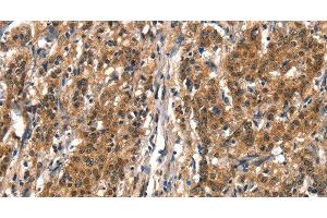 Immunohistochemistry of paraffin-embedded Human gastric cancer tissue using DDX4 Polyclonal Antibody at dilution 1:40 (DDX4 antibody)