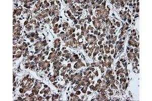 Immunohistochemical staining of paraffin-embedded Carcinoma of liver tissue using anti-FAHD2A mouse monoclonal antibody. (FAHD2A antibody)