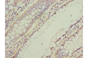 Immunohistochemistry of paraffin-embedded human colon cancer using ABIN7161338 at dilution of 1:100 (NMUR1 antibody  (AA 360-426))