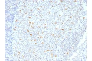 Formalin-fixed, paraffin-embedded human Hodgkin's Lymphoma stained with BCL-6 Mouse Monoclonal Antibody (BCL6/1526). (BCL6 antibody  (AA 256-389))