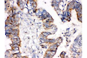 Anti- IGFBP3 Picoband antibody, IHC(P) IHC(P): Human Intestinal Cancer Tissue (IGFBP3 antibody  (C-Term))