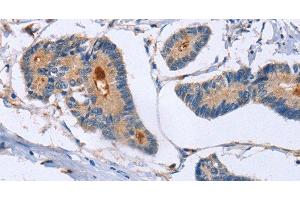 Immunohistochemistry of paraffin-embedded Human colon cancer using GMFG Polyclonal Antibody at dilution of 1:50 (GMFG antibody)