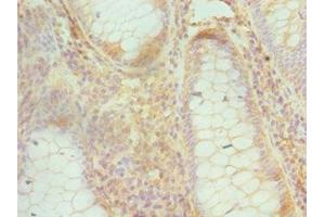 Immunohistochemistry of paraffin-embedded human colon cancer using ABIN7148748 at dilution of 1:100 (Cullin 1 antibody  (AA 500-776))