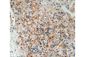 Used in DAB staining on fromalin fixed paraffin- embedded kidney cancer tissue (TOR1AIP2 antibody  (AA 249-476))