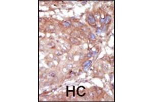 Formalin-fixed and paraffin-embedded human cancer tissue reacted with the primary antibody, which was peroxidase-conjugated to the secondary antibody, followed by AEC staining. (TNK2 antibody  (C-Term))