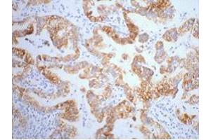 Immunohistochemistry (IHC) staining of Human Lung Cancer tissue, diluted at 1:200. (Cytokeratin 7 antibody)