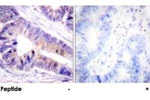 Immunohistochemical analysis of paraffin-embedded human colon carcinoma tissue using YWHAZ polyclonal antibody . (14-3-3 zeta antibody)