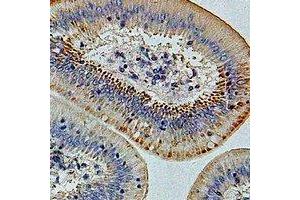 Immunohistochemical analysis of IFI44 staining in human colon cancer formalin fixed paraffin embedded tissue section. (IFI44 antibody)