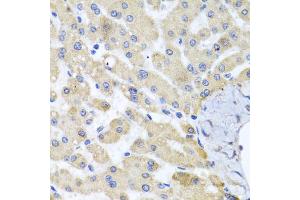 Immunohistochemistry of paraffin-embedded human liver injury using ABCB8 antibody (ABIN5974712) at dilution of 1/100 (40x lens). (ABCB8 antibody)