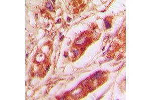 Immunohistochemical analysis of Vimentin staining in human lung cancer formalin fixed paraffin embedded tissue section.