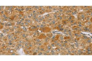 Immunohistochemistry of paraffin-embedded Human liver cancer using TP53I11 Polyclonal Antibody at dilution of 1:40 (TP53I11 antibody)